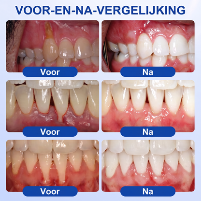 🏅🧸𝐺𝑙𝑖𝑚𝘮𝘦𝘳𝘭𝘺® 🦷 GUMREVIVE PERIODONTAAL REPARATIEGEL